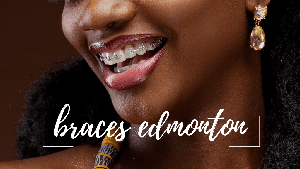 Best Braces in Edmonton