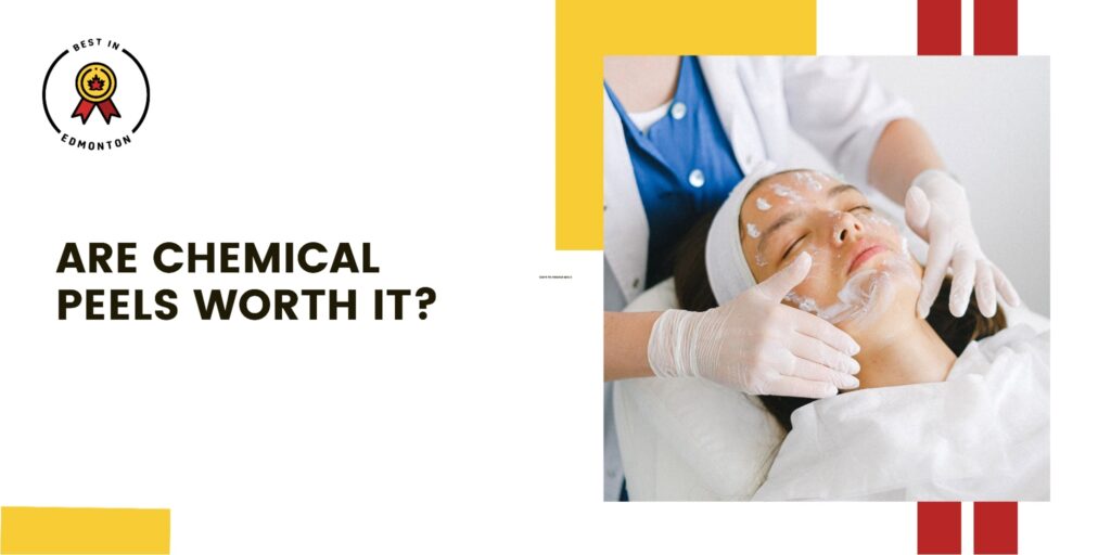 Are Chemical Peels Worth it