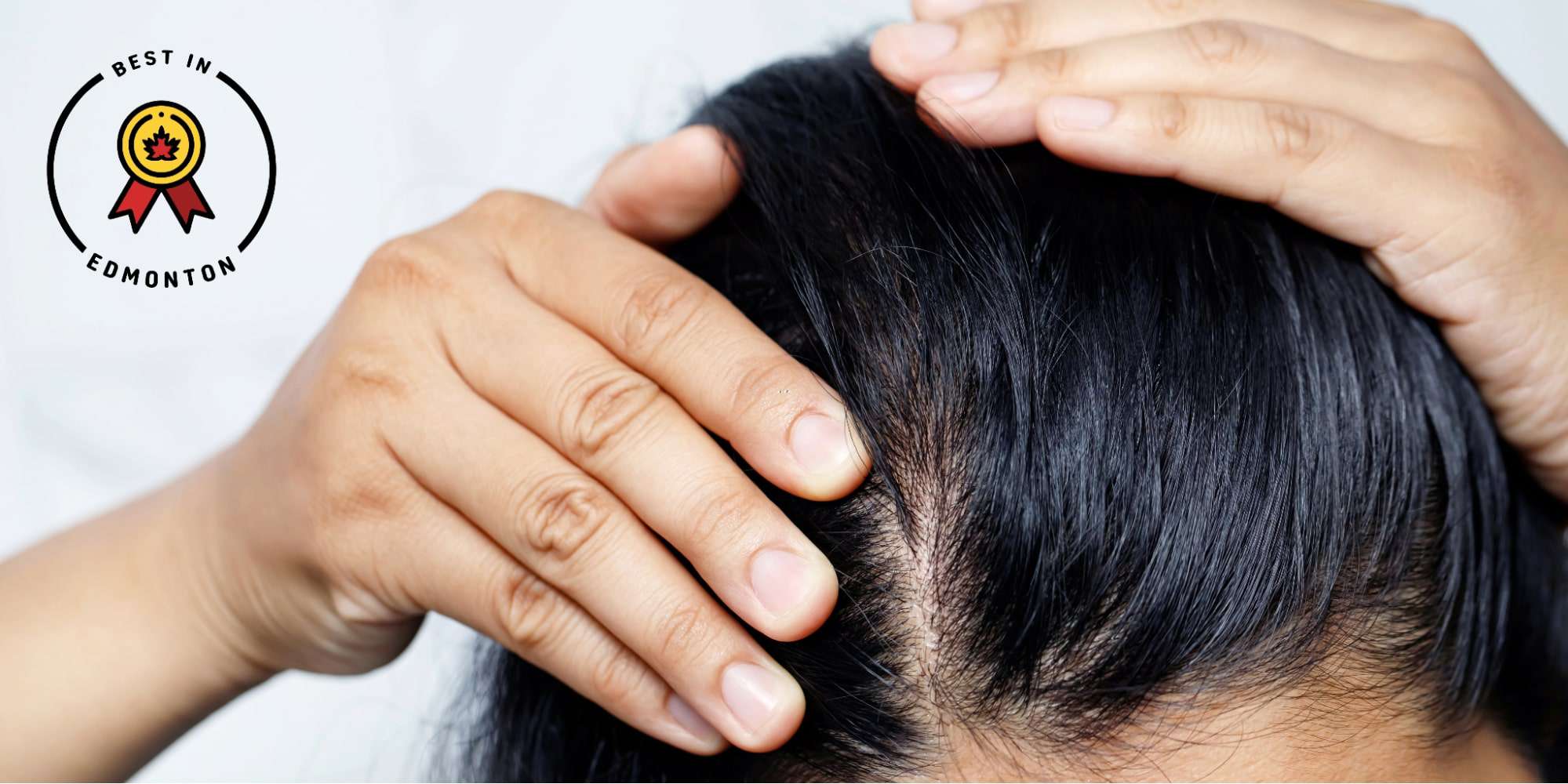 Top 5 Places for Scalp Micropigmentation in Edmonton