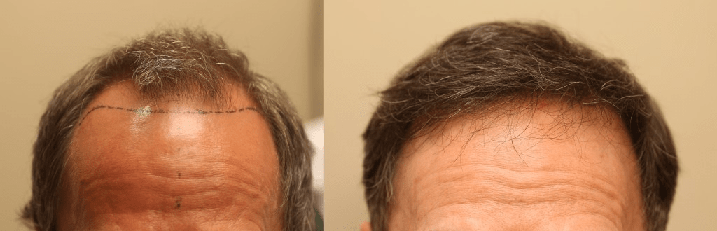 Nakatsui Dermasurgery's Before & After Hair Transplant