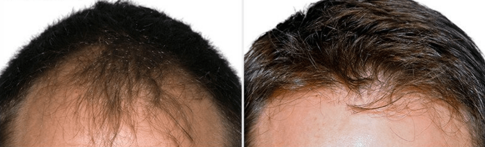 Nuhair Transplants' Before & After
