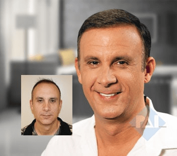 PAI Medical Hair Restoration's Before & After Hair Transplant