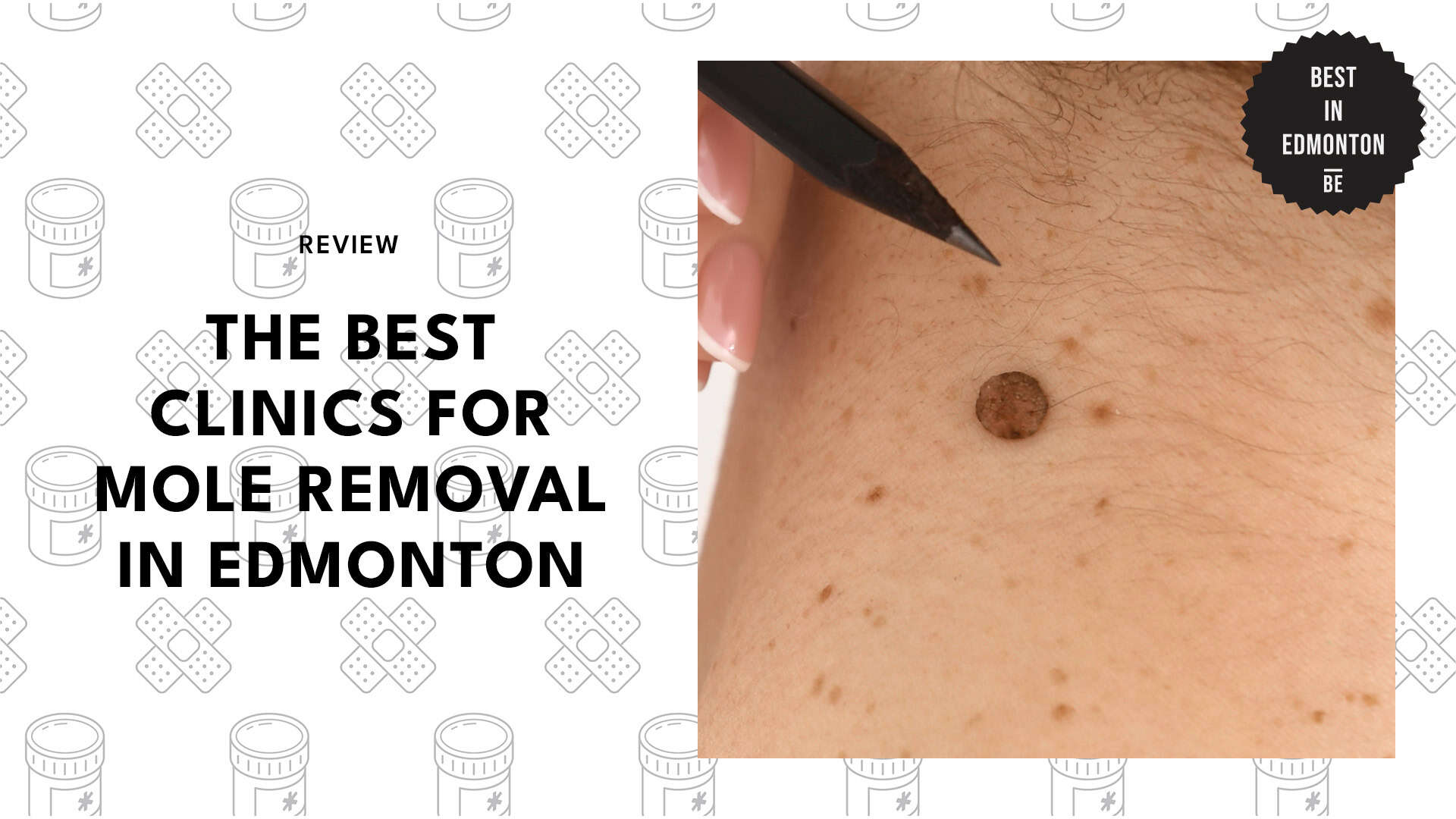 mole-removal-edmonton