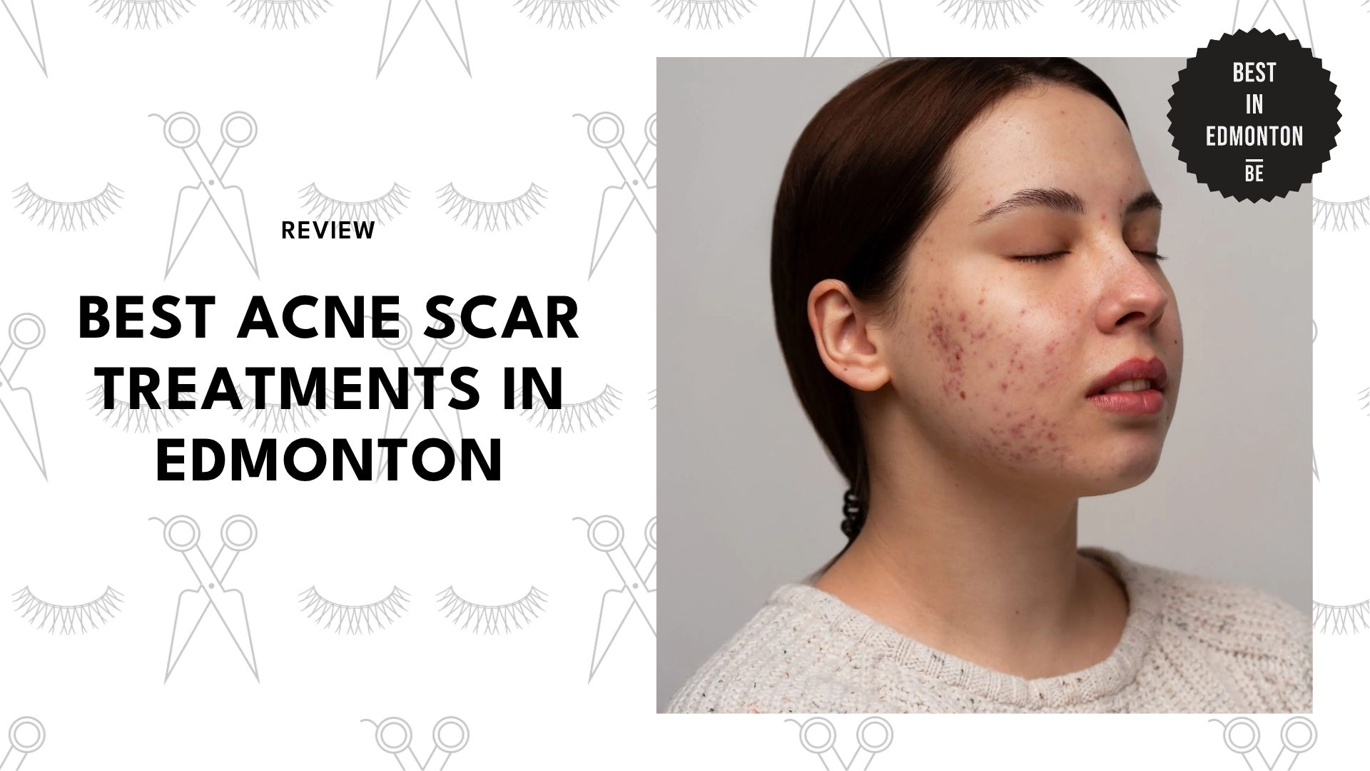 best-acne-scar-treatments-edmonton